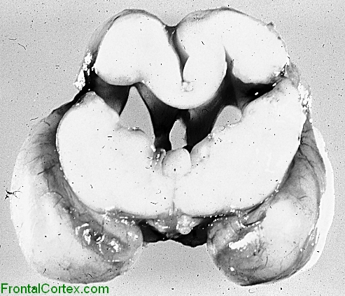 Schizencephaly, coronal section of brain.